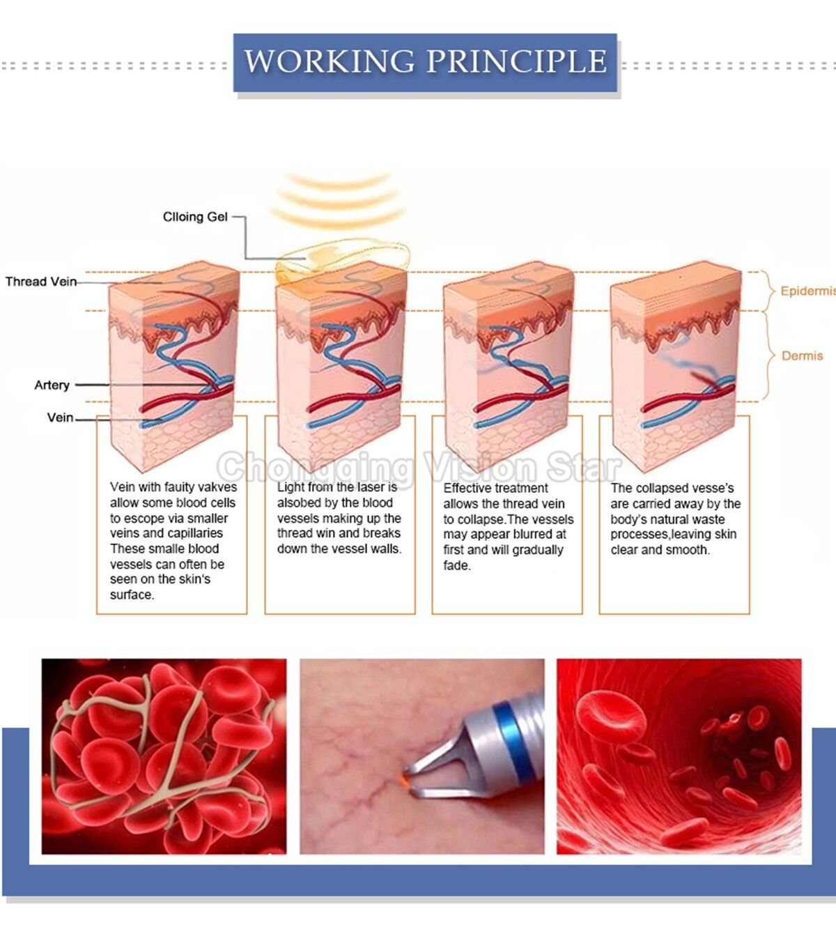 HYB-980nm Diode Laser Spridervein Removal&Target Redness