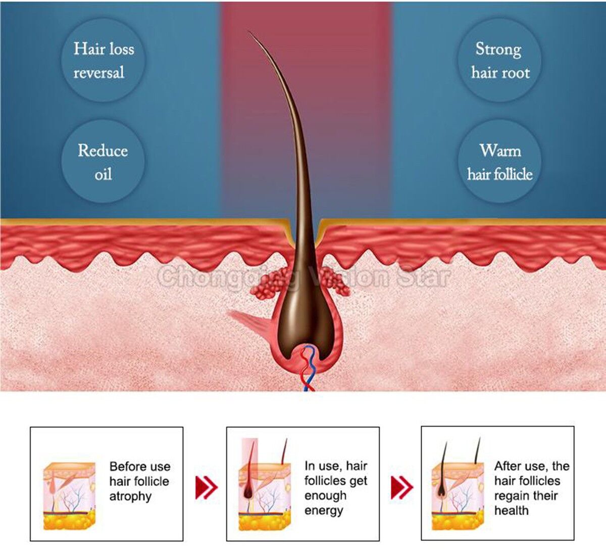 HYB-LaserH Laser Hair Regrowth Machine